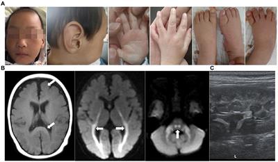 Novel TP53RK variants cause varied clinical features of Galloway–Mowat syndrome without nephrotic syndrome in three unrelated Chinese patients